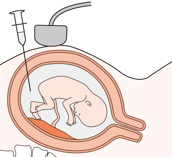 針先： 羊膜腔